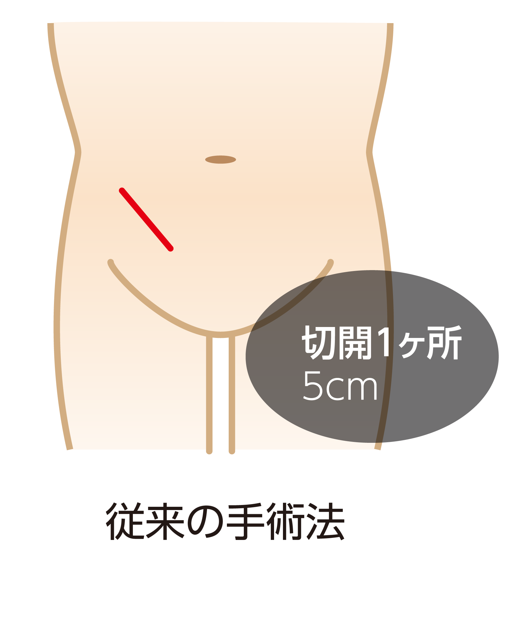 単孔式腹腔鏡下鼠径ヘルニア根治術(SILS-TEP法)
