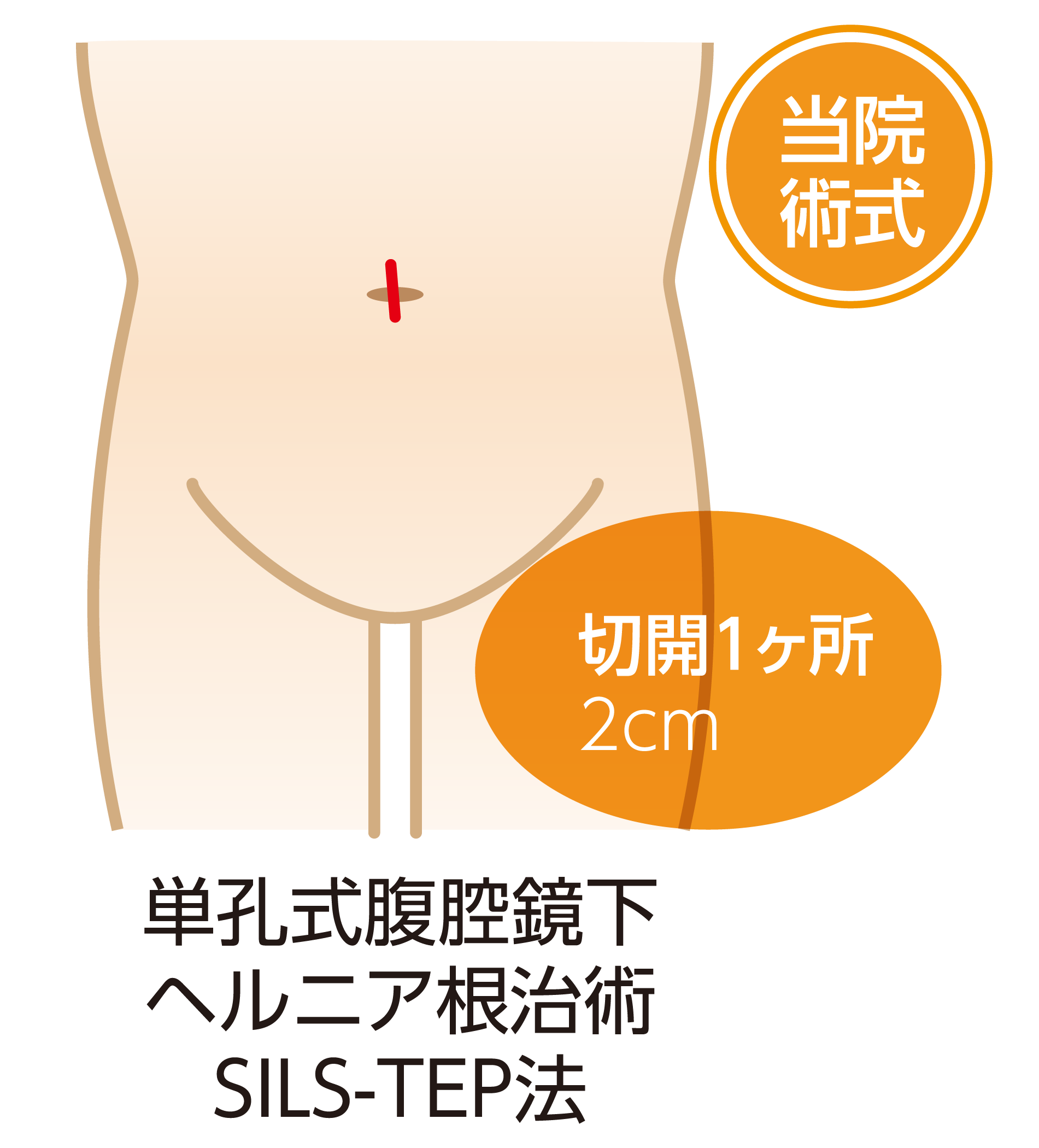 単孔式腹腔鏡下鼠径ヘルニア根治術(SILS-TEP法)