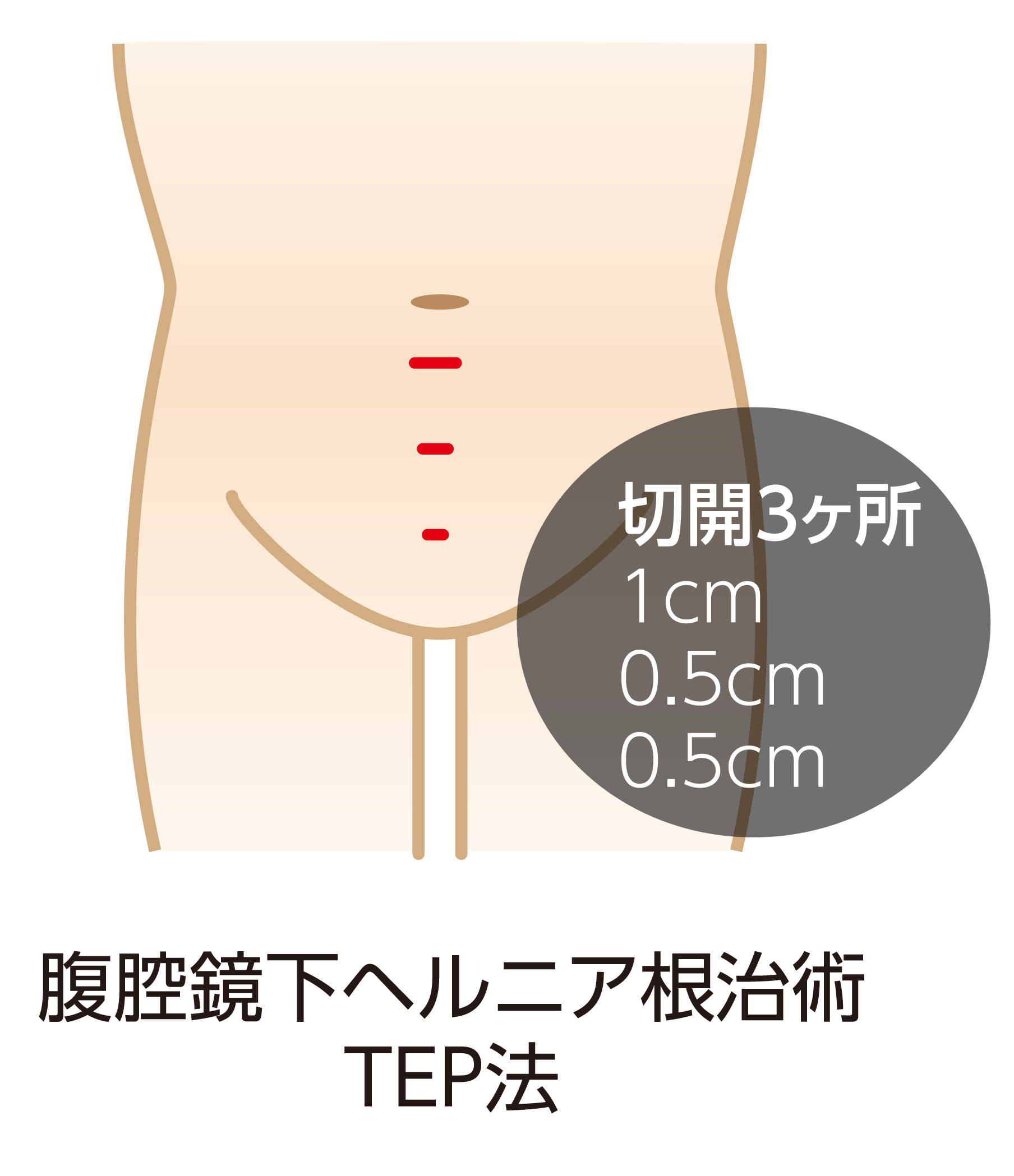 単孔式腹腔鏡下鼠径ヘルニア根治術(SILS-TEP法)