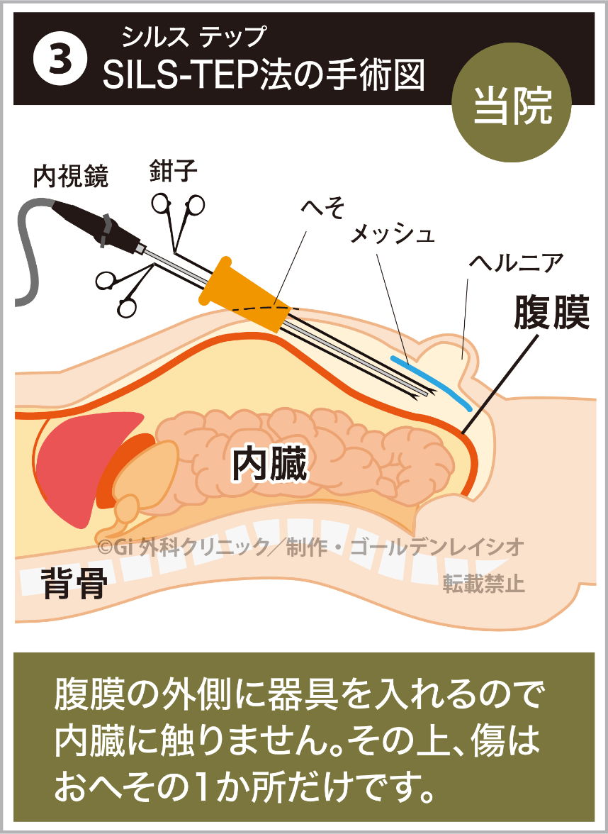 ③SILS-TEP（シルステップ）法の手術図。腹膜の外側に器具を入れるので内臓に触りません。その上、傷はおへその1か所だけです。