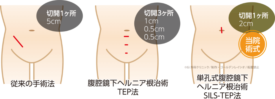 従来の手術法：切開1ヶ所5cm。腹腔鏡下ヘルニア根治術TEP（テップ）法：切開3ヶ所1cm、0.5cm、0.5cm。単孔式服腔鏡下ヘルニア根治術SILS-TEP（シルステップ）法：切開1ヶ所2cm、当院術式。