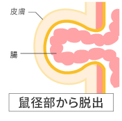 嵌頓（かんとん）による命の危険